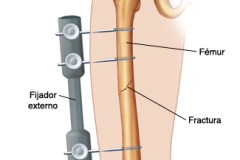 Femur fracture with External fixation device

referenced from WWW:
http://www.thehawaiichannel.com/2006/0209/6866905.jpg